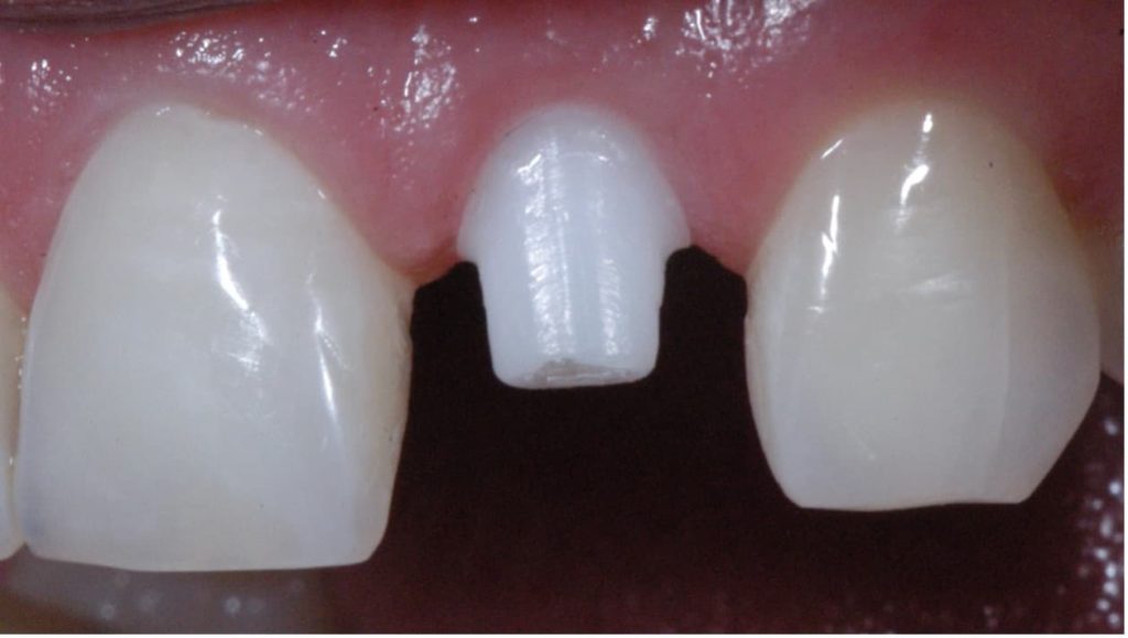 Zagojone dziąsło po założeniu implantu ceramicznego